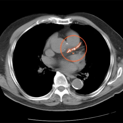 McLaren Health Care Launches First-of-its-Kind AI-Powered Cardiovascular Screening in Michigan